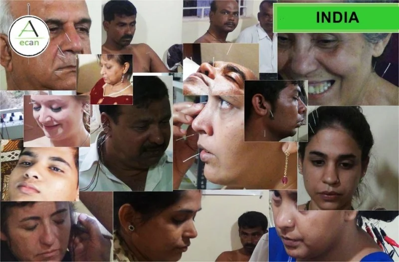 Collage de sesiones de acupuntura con pacientes durante los Cursos Intensivos de ECAN en India