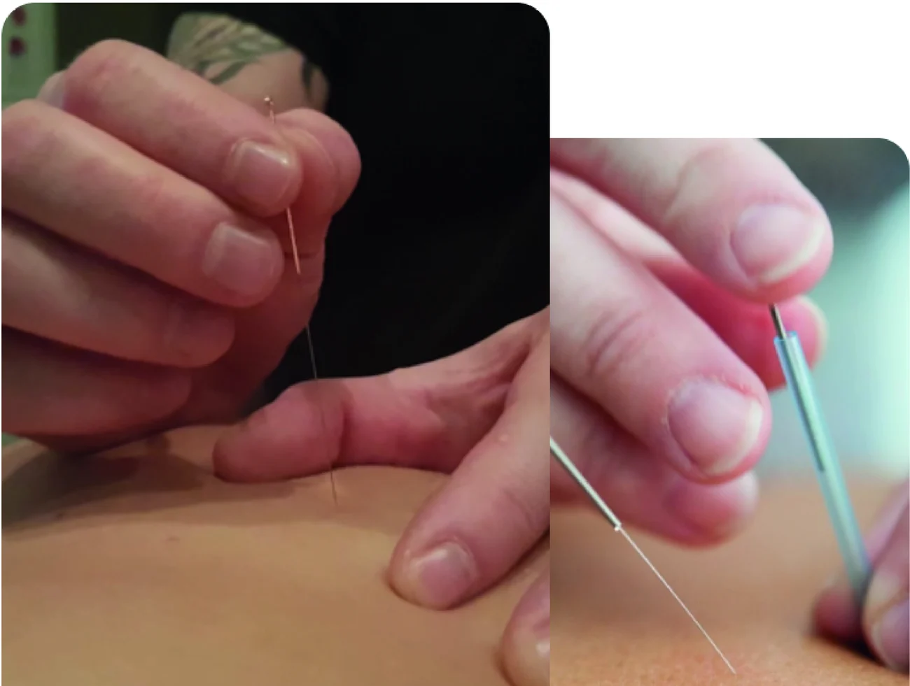 Aplicación de agujas de acupuntura